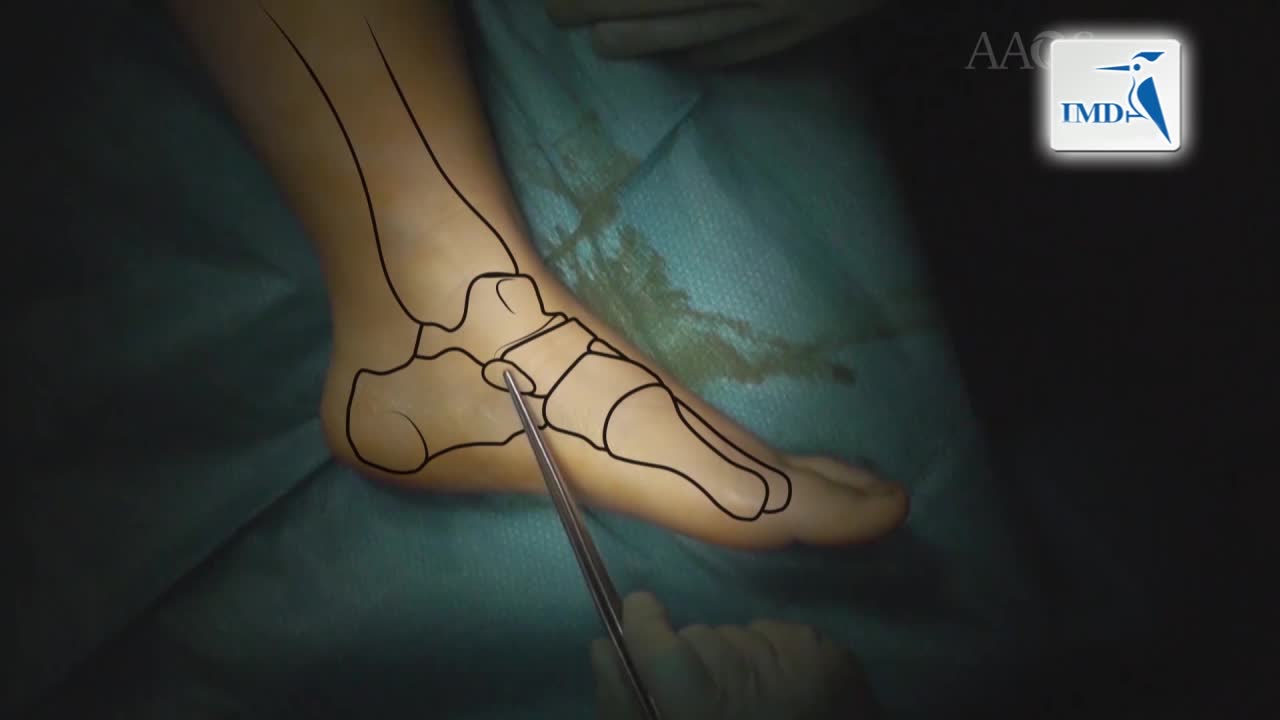 儿童易变性平足症手术治疗方法（3）