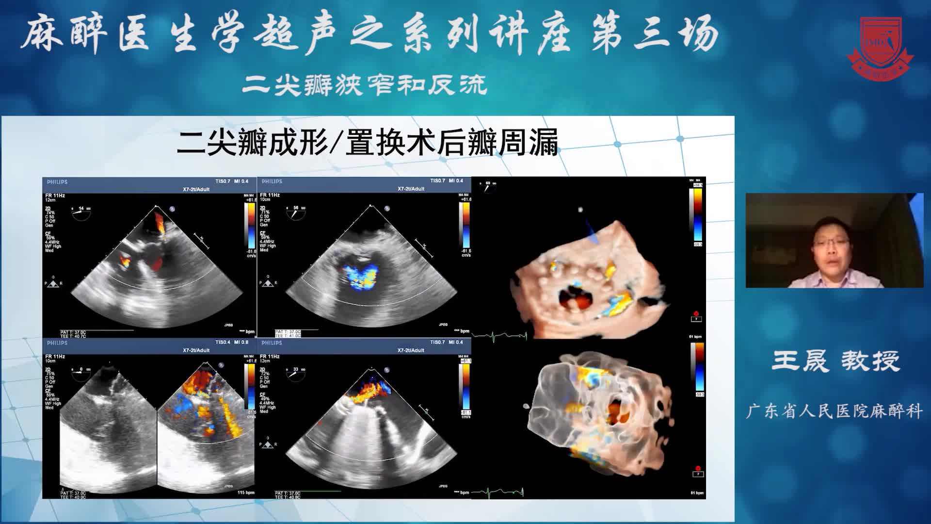 二尖瓣狭窄和反流  王晟 教授 03