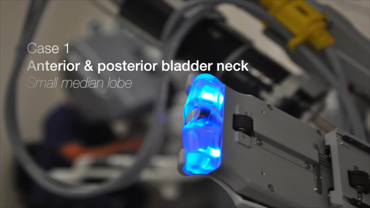 Technical aspects of robot-assisted laparoscopic prostate..-