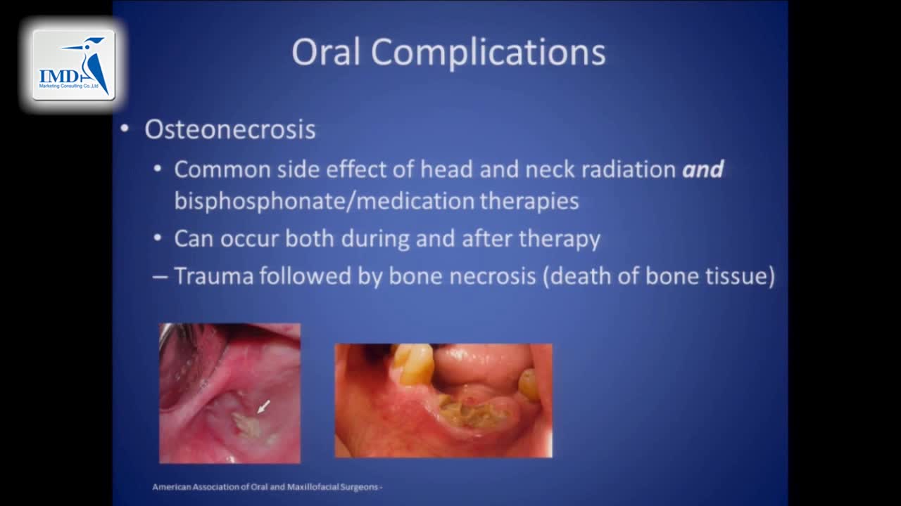 11__癌症治疗后如何管理牙齿健康