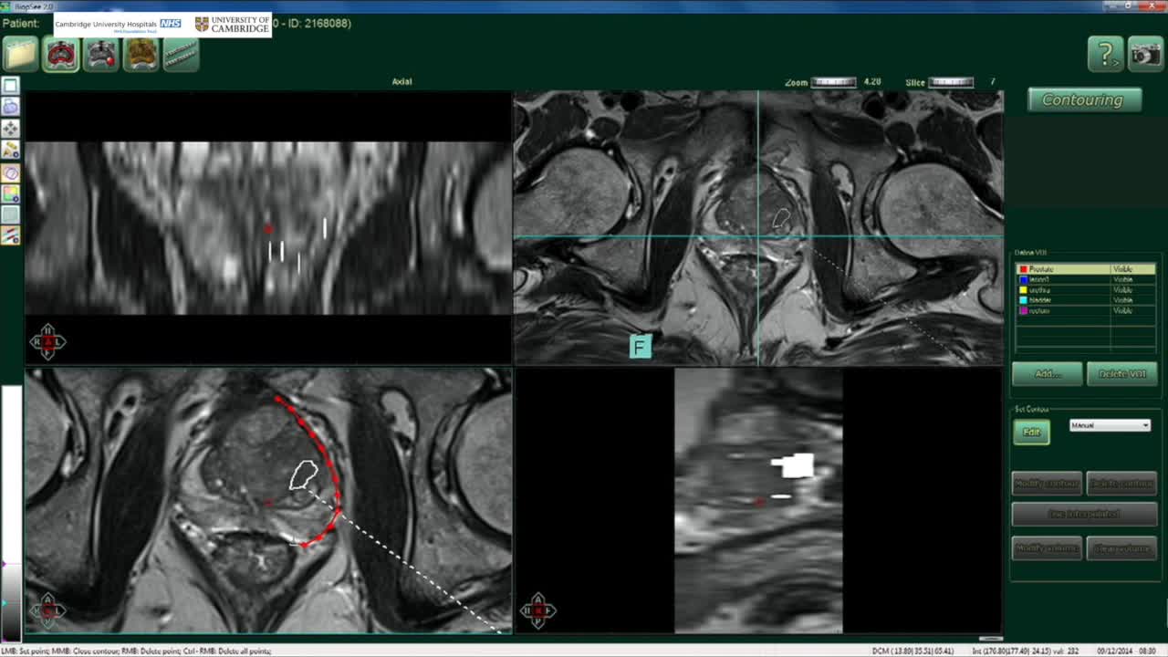 MRI-TRUS fusion guided transperineal prostate biopsy acco..-