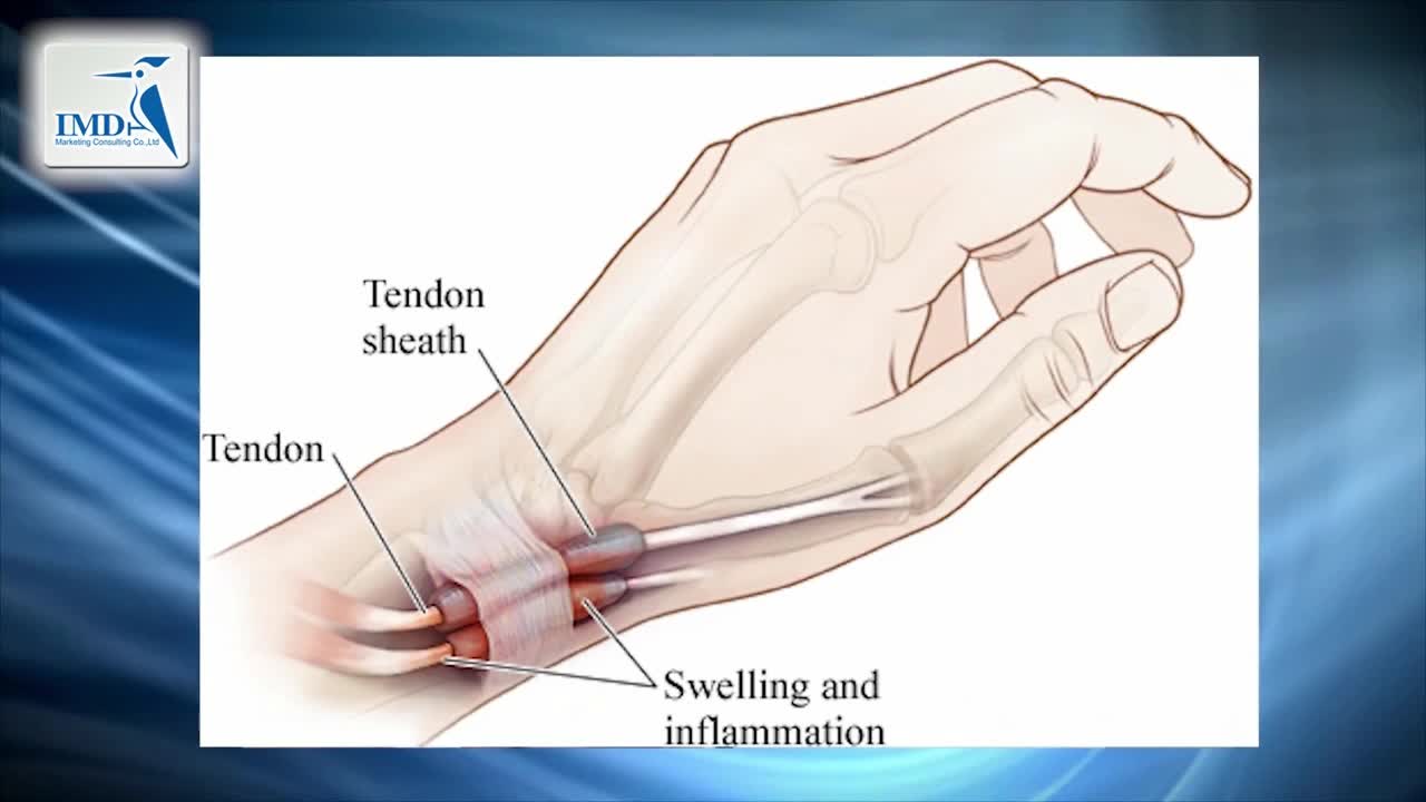 狄魁文氏症候群