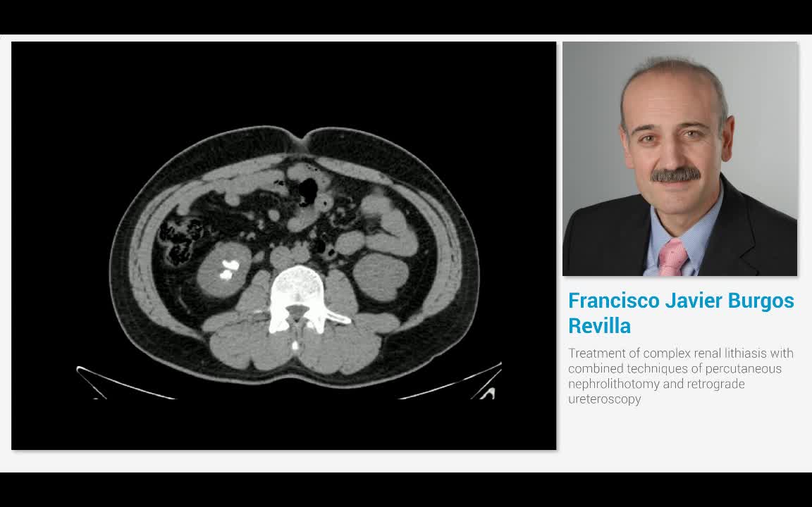 Treatment of complex renal lithiasis with combined techni..-
