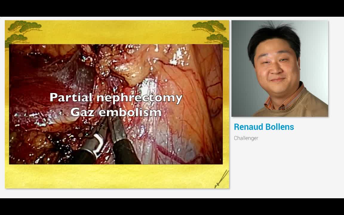 Partial robot-assisted laparoscopic nephrectomy - Challen..-