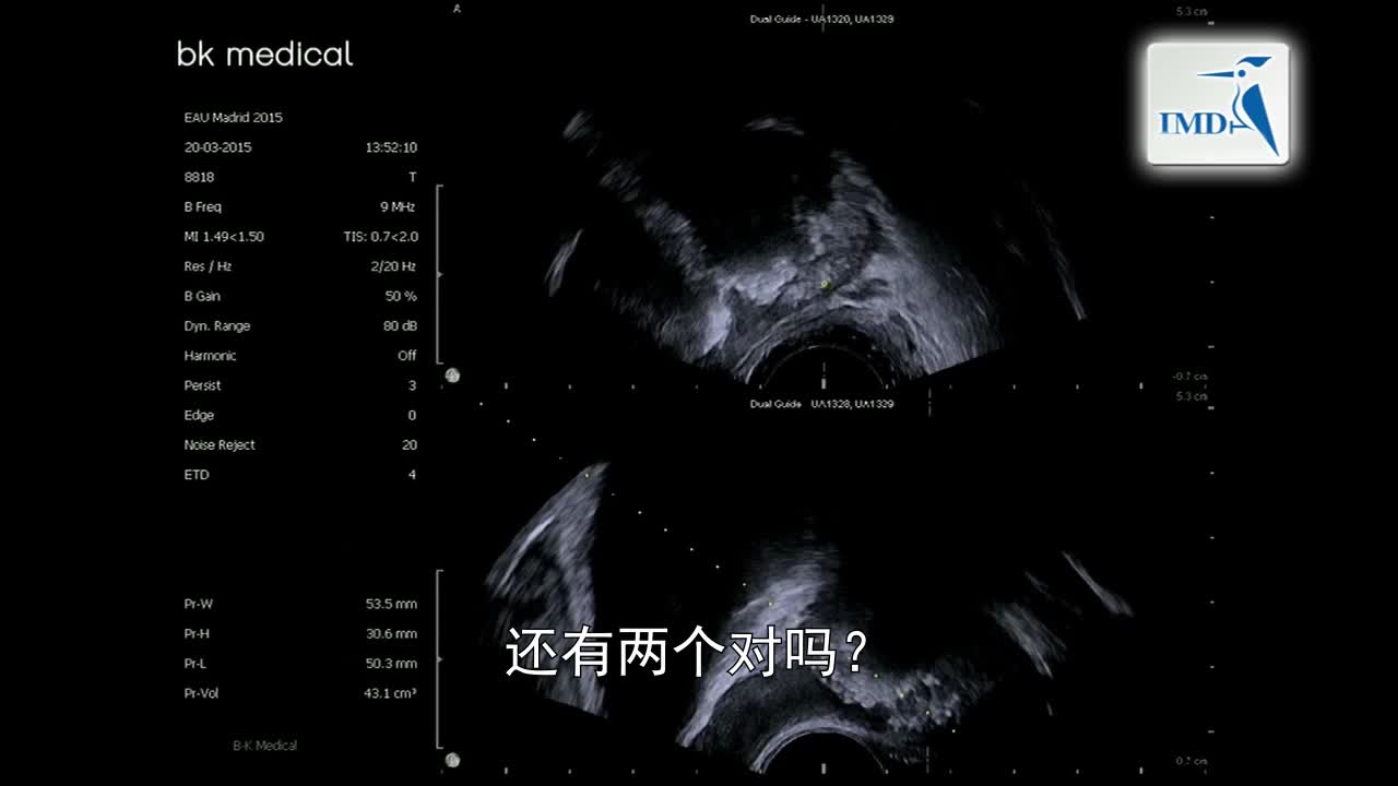 经直肠超声前列腺活检（2）