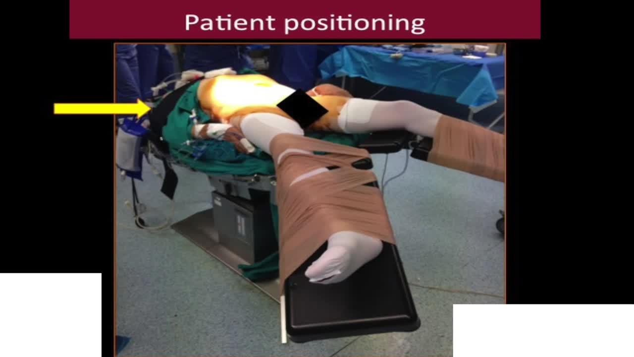 Robotic intracorporeal Indiana pouch, Replicating open su..-