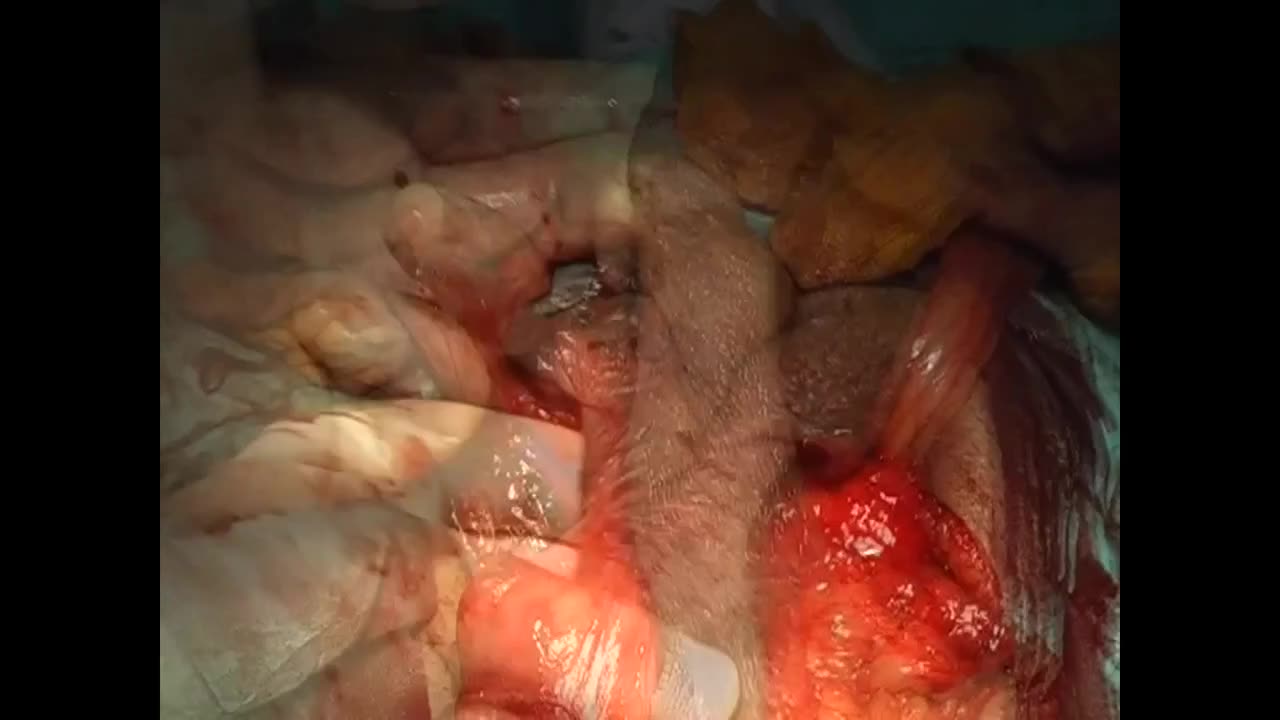 Substitution urethroplasty with biaxial epilated scrotal ..-