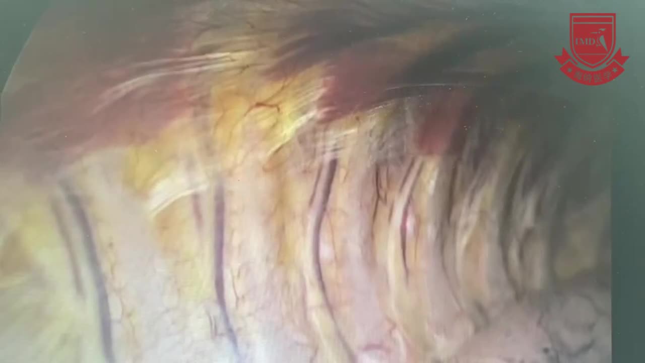 索龙龙-食管癌根治术