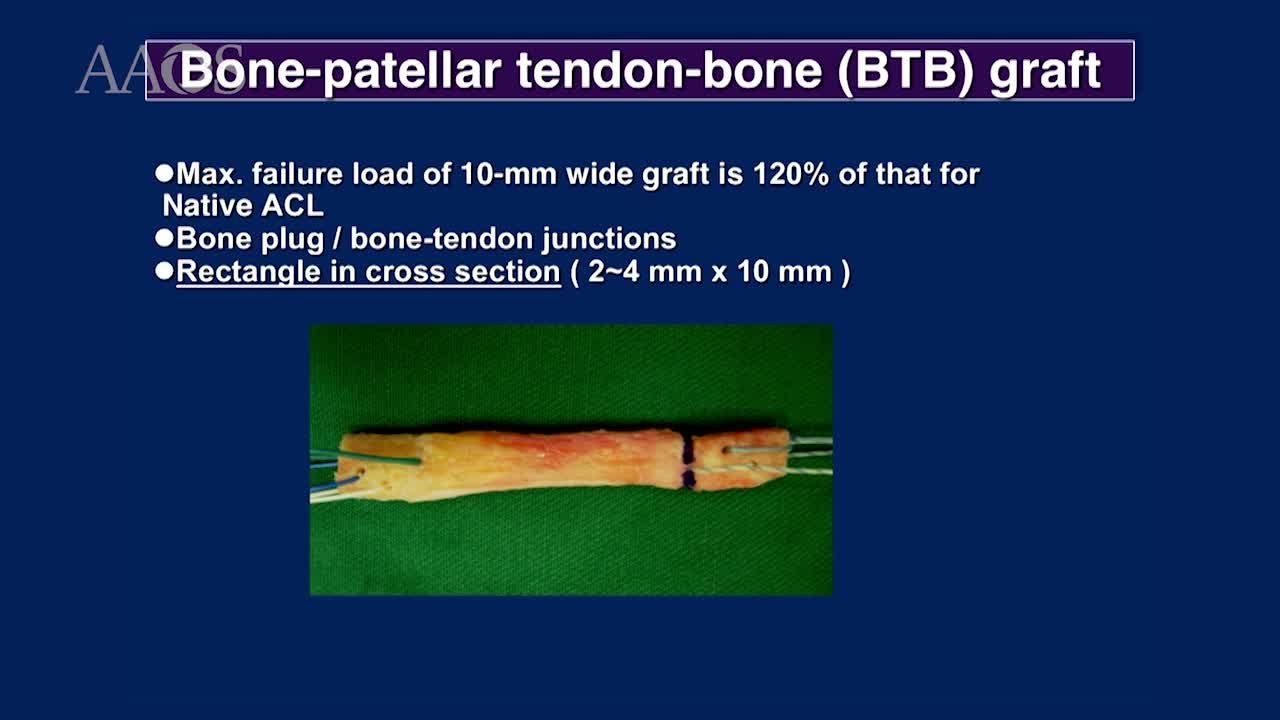 Anatomical Rectangular Tunnel ACL Reconstruction with a BTB Graft