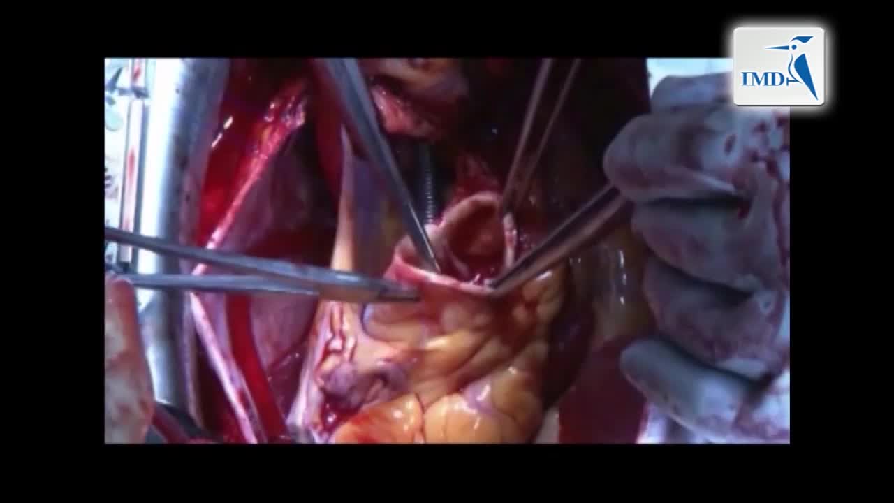 保留瓣膜的主动脉根部置换术（1）