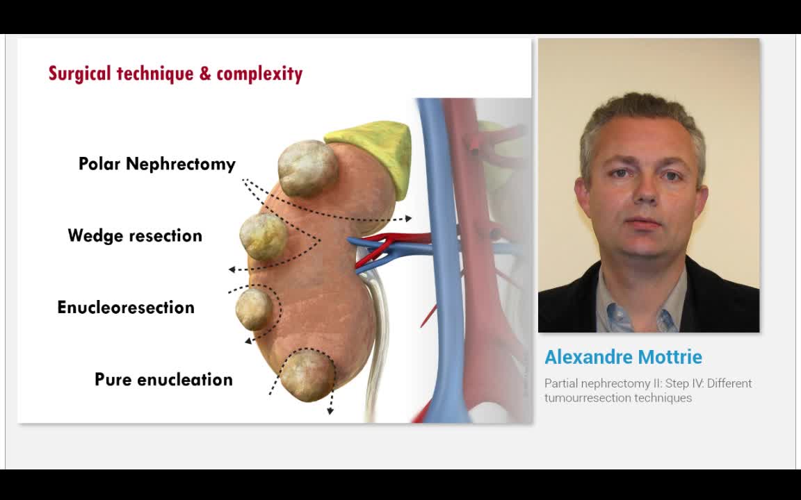 Partial nephrectomy II, Step IV, Different tumourresectio..-