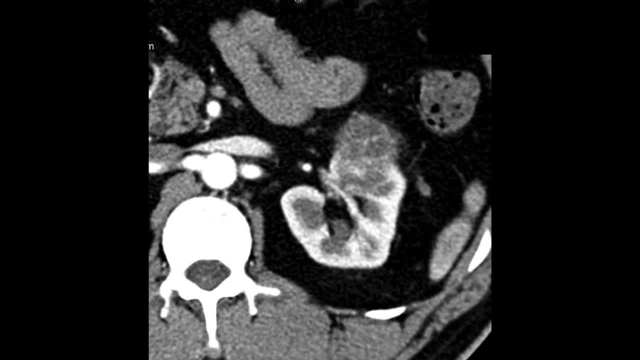 Extending the limits, Fluorescence guided selective arter..-