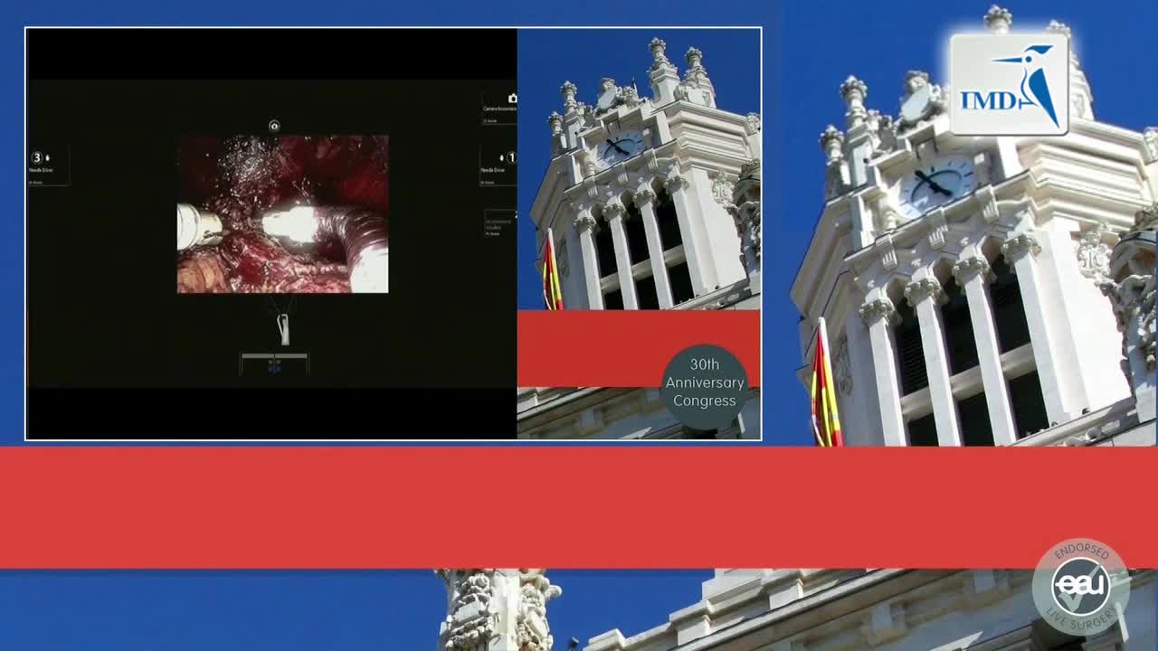 根治性前列腺切除单口手术（2）