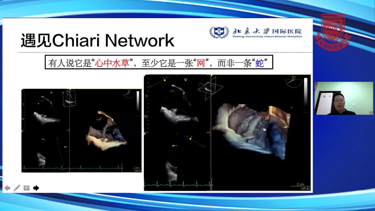 从&ldquo;结构显像&rdquo;到&ldquo;容积定量&rdquo;34D TEE在心脏手术中的应用--朱斌（4）