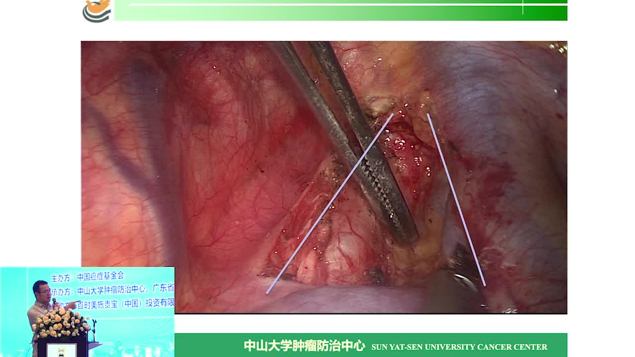 ⅢA期肺癌根治术后辅助放化疗的选择