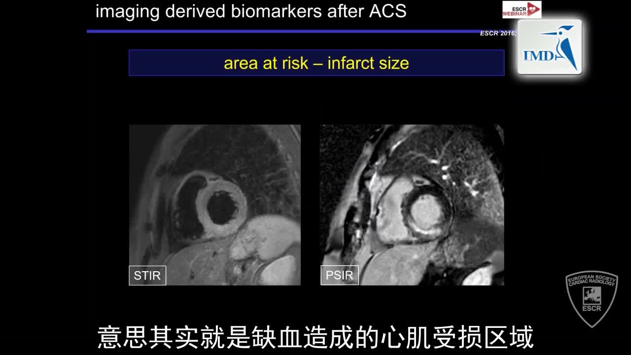 急性冠状动脉综合征发作后的影像诊断（6）