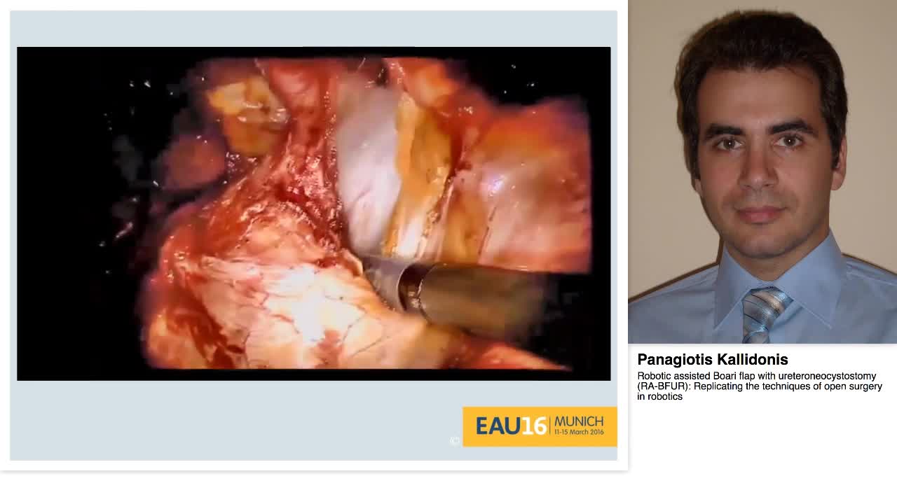 Robotic assisted Boari flap with ureteroneocystostomy (RA-