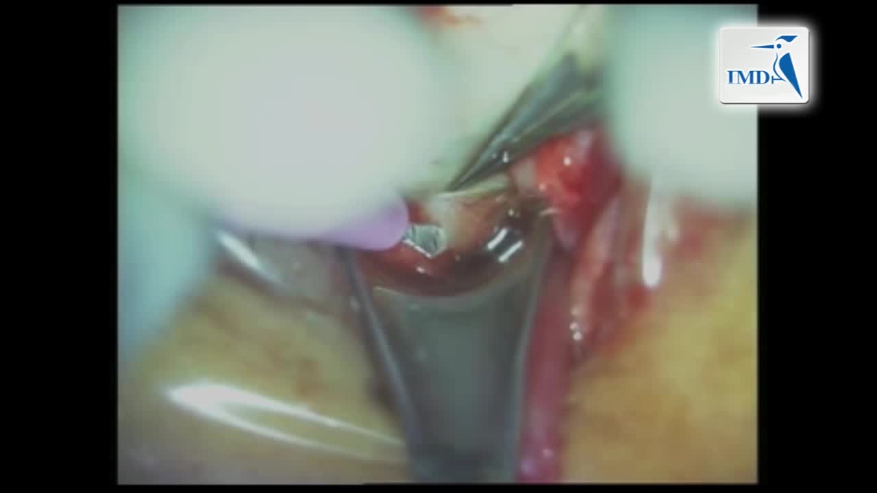 视神经鞘开窗术（2）