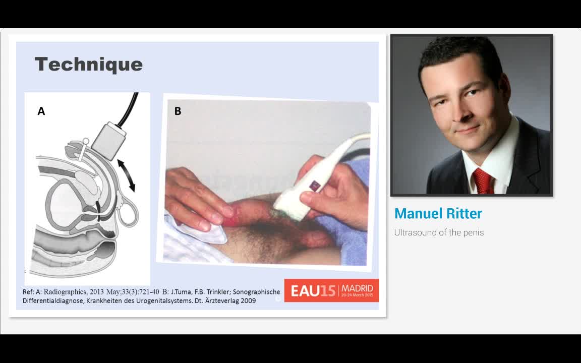 Ultrasound of the penis