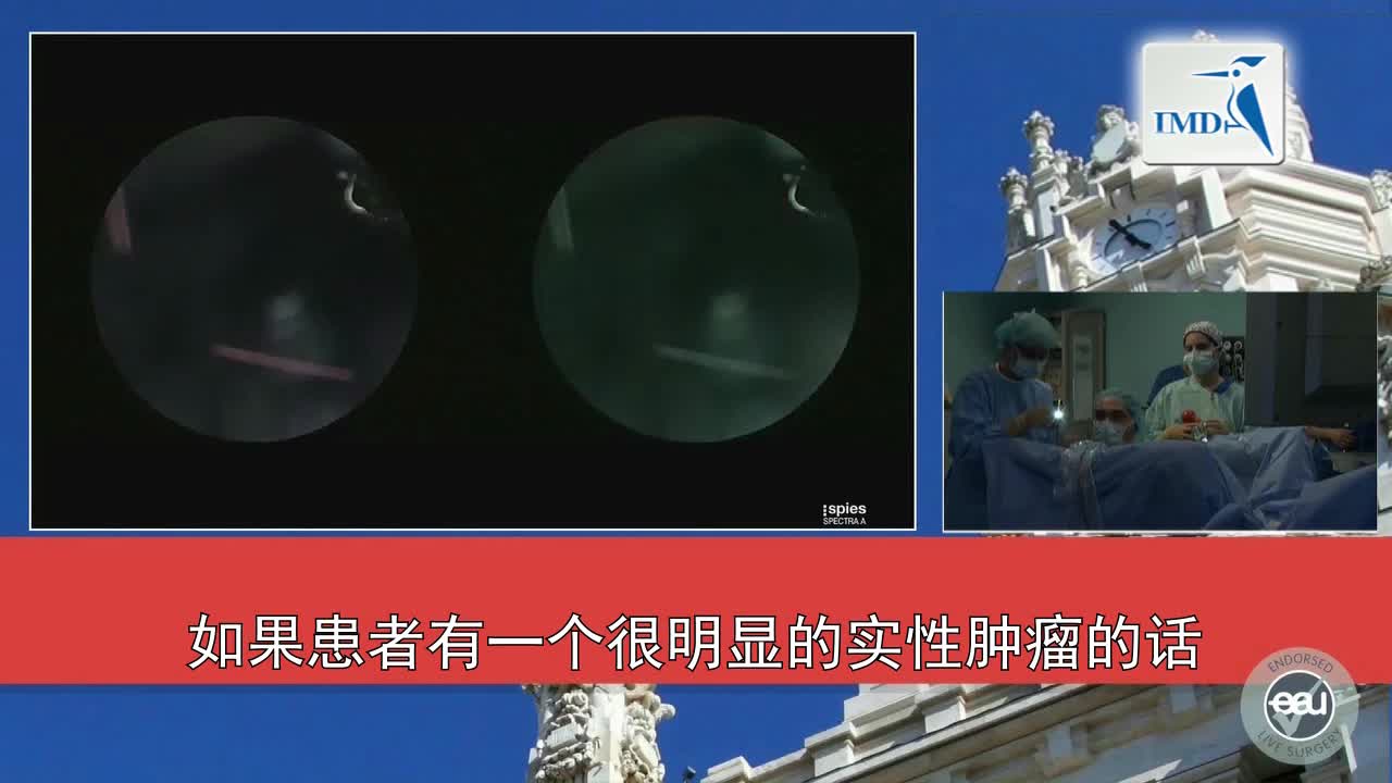 经尿道膀胱肿瘤切除手术（4）