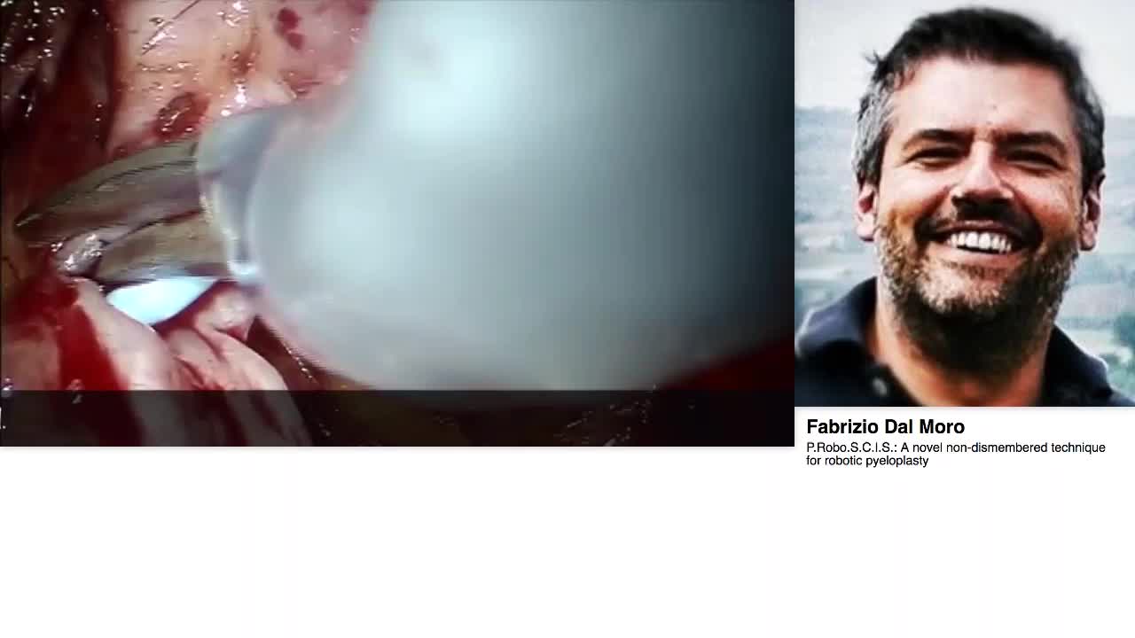 P.Robo.S.C.I.S., A novel non-dismembered technique for ro-