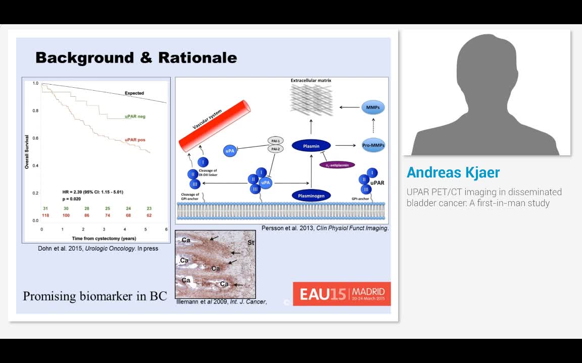 UPAR PET-CT imaging in disseminated bladder cancer, A fir..-