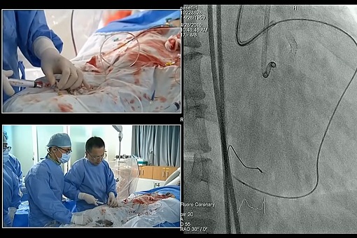 血管内手术现场案例（2）