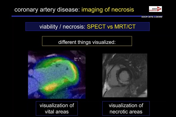 《心血管科》2018年第7讲（总第81讲）：急性冠状动脉综合征发作后的影像诊断（7）