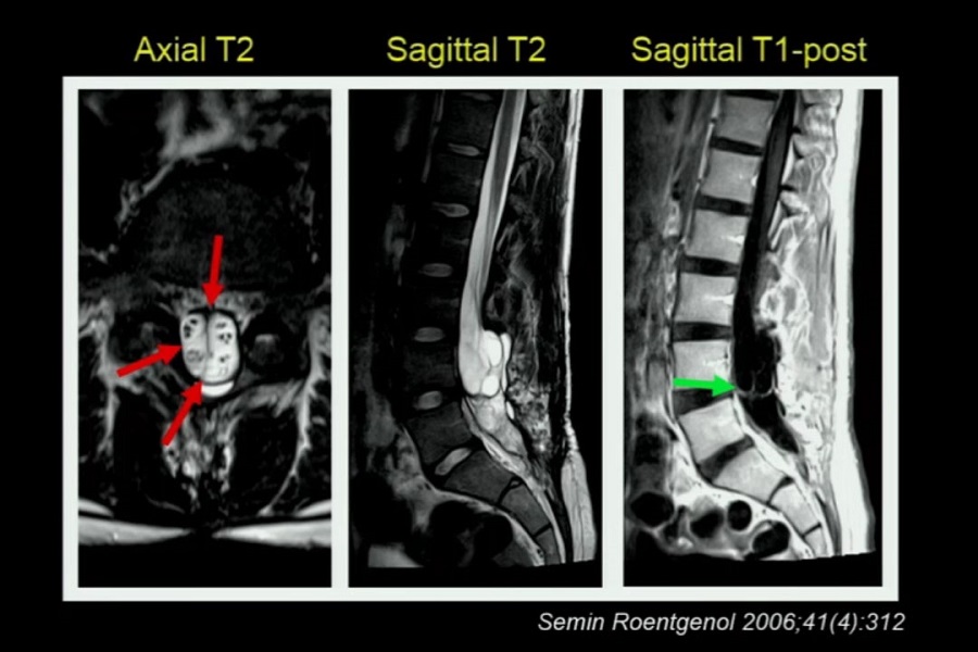 《医学放射科》2019年第2讲（总第103讲）基于病例学习神经影像学（2）