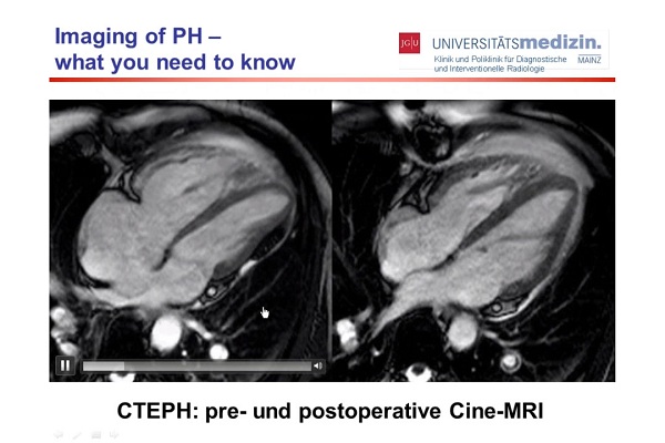肺动脉高压显像&mdash;&mdash;你需要了解的知识（4）