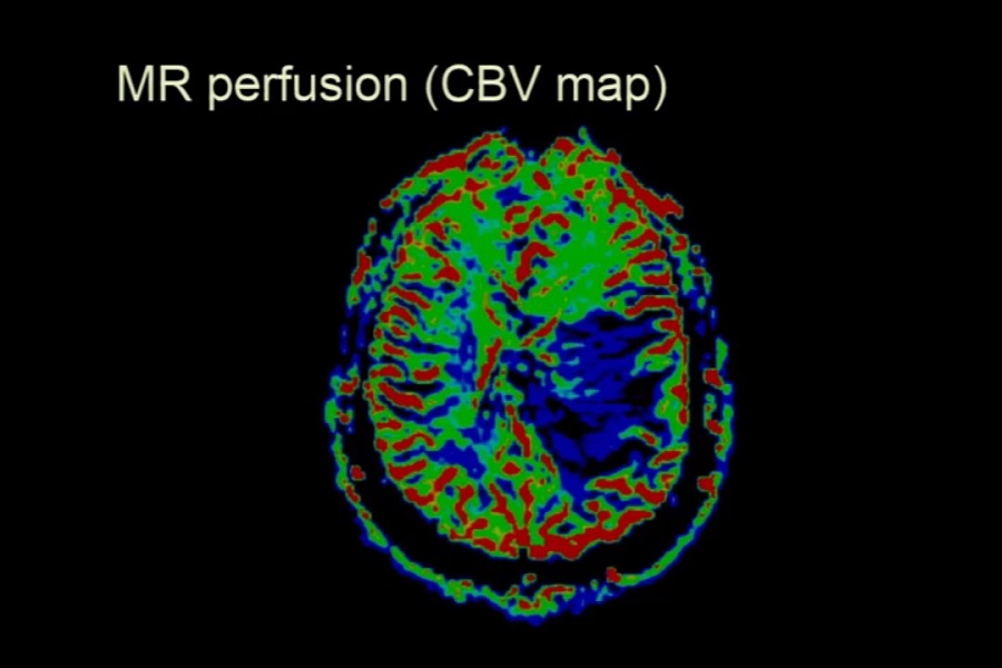 《医学放射科》2019年第4讲（总第105讲）基于病例学习神经影像学（4）