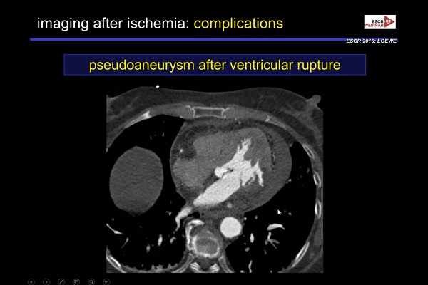 《心血管科》2018年第10讲（总第84讲）：急性冠状动脉综合征发作影像诊断（10）