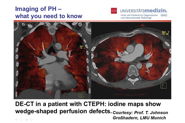 肺动脉高压显像&mdash;&mdash;你需要了解的知识（2）