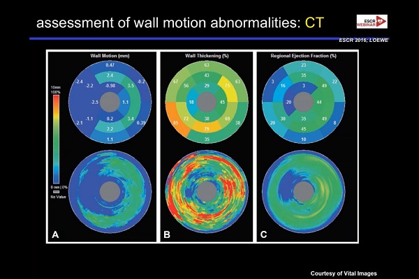 《心血管科》2018年第5讲（总第79讲）：急性冠状动脉综合征发作后的影像诊断（5）
