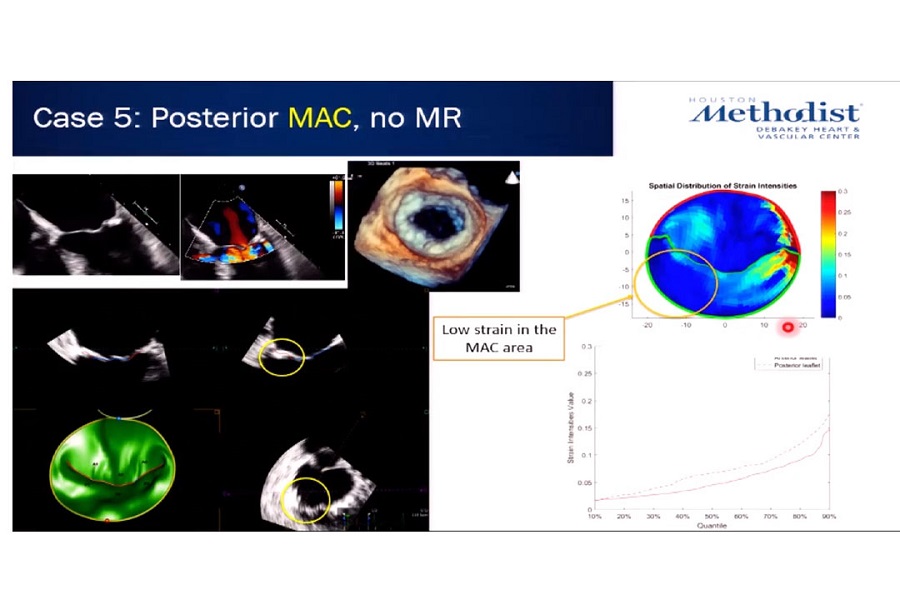 《胸外科》二尖瓣结构与功能（4）