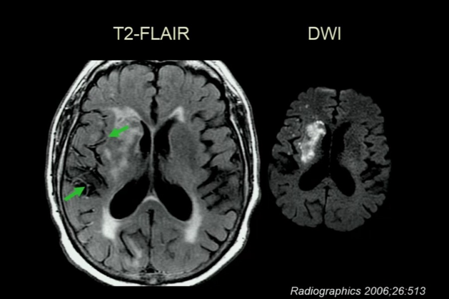 《医学放射科》2019年第1讲（总第102讲）基于病例学习神经影像学（1）