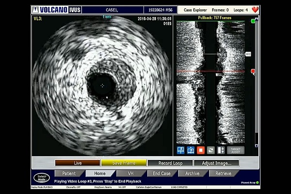 血管内手术现场案例（6）