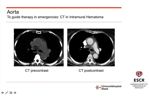 《心血管科》2018年第16讲（总第90讲）成像在器质性心脏病现代治疗中的作用（4）