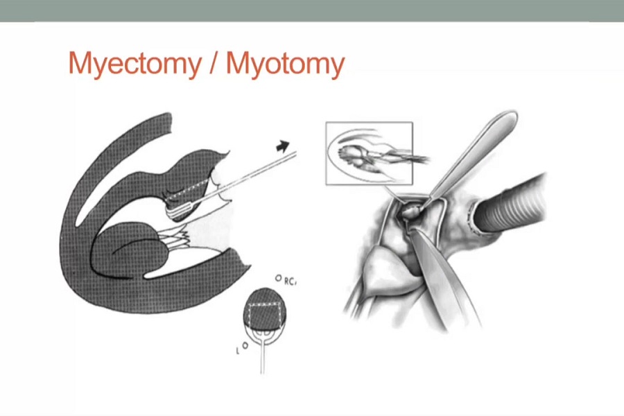 《胸外科》主动脉根部拓宽术和主动脉瓣重建术（3）