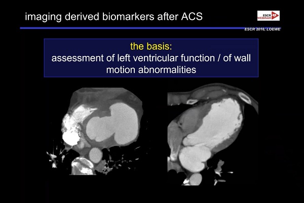 《心血管科》2018年第4讲（总第78讲）：急性冠状动脉综合征发作后的影像诊断（4）