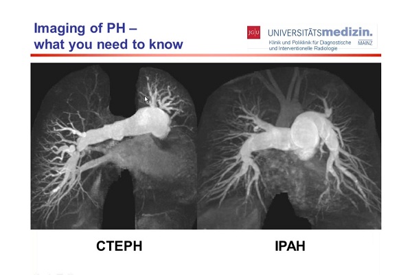 肺动脉高压显像&mdash;&mdash;你需要了解的知识（1）