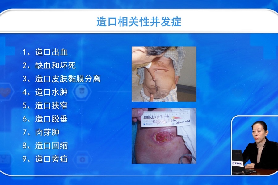 《护理大讲堂》2019年第9讲（总第9讲）造口并发症