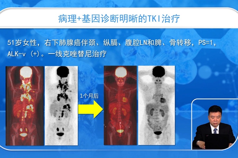 《肿瘤科》2018年第23讲（总第235讲）NSCLC分子靶向治疗进展与问题（3）