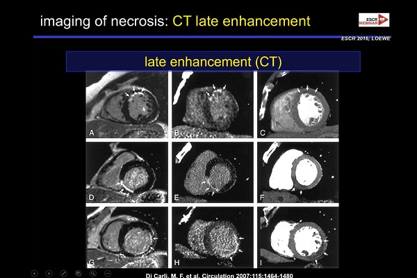《心血管科》2018年第8讲（总第82讲）：急性冠状动脉综合征发作后的影像诊断（8）