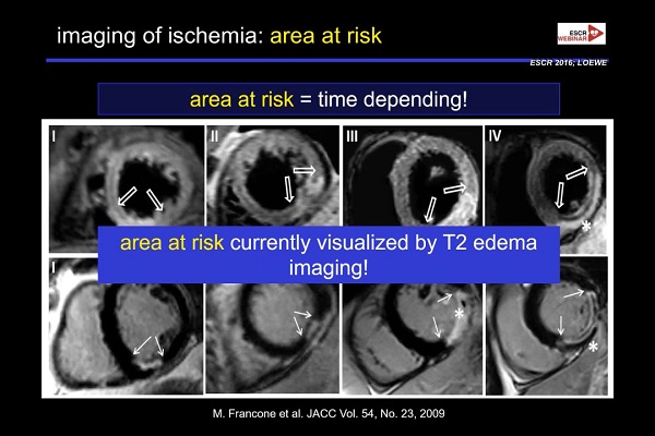 《心血管科》2018年第6讲（总第80讲）：急性冠状动脉综合征发作后的影像诊断（6）