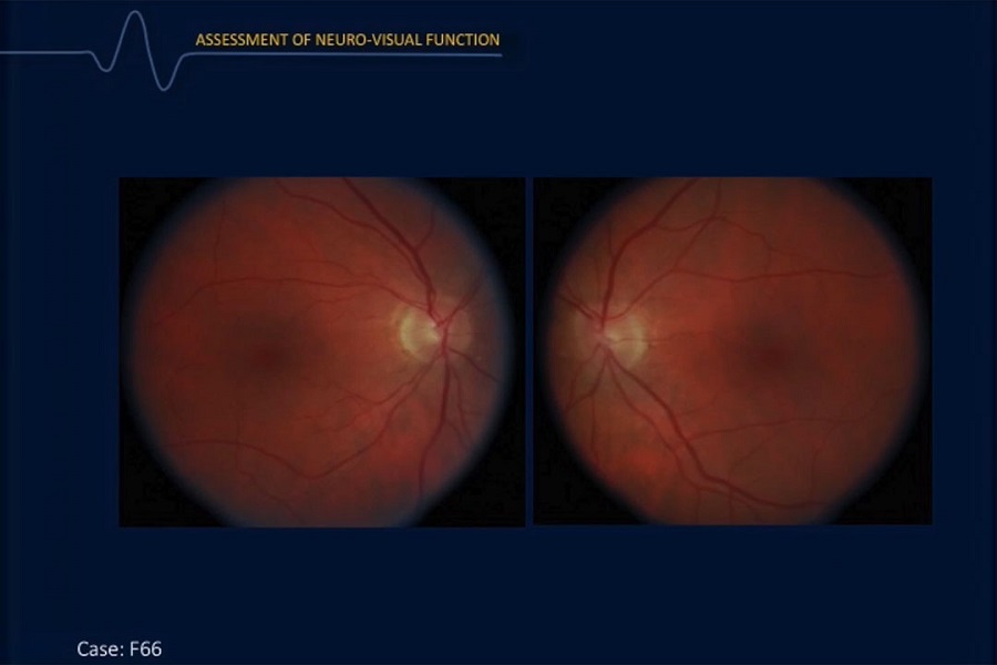 《眼科》2018年第4讲（总第29讲）视网膜电图在视网膜疾病诊断和管理中的作用（4）