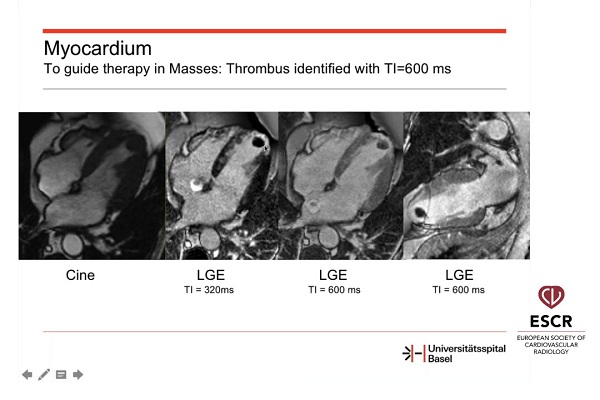 成像在器质性心脏病现代治疗中的作用（2）