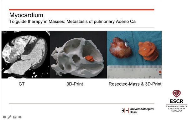 《心血管科》2018年第14讲（总第88讲）成像在器质性心脏病现代治疗中的作用（2）