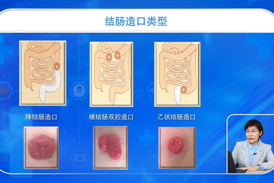 《护理大讲堂》2019年第1讲（总第1讲）造口术前护理
