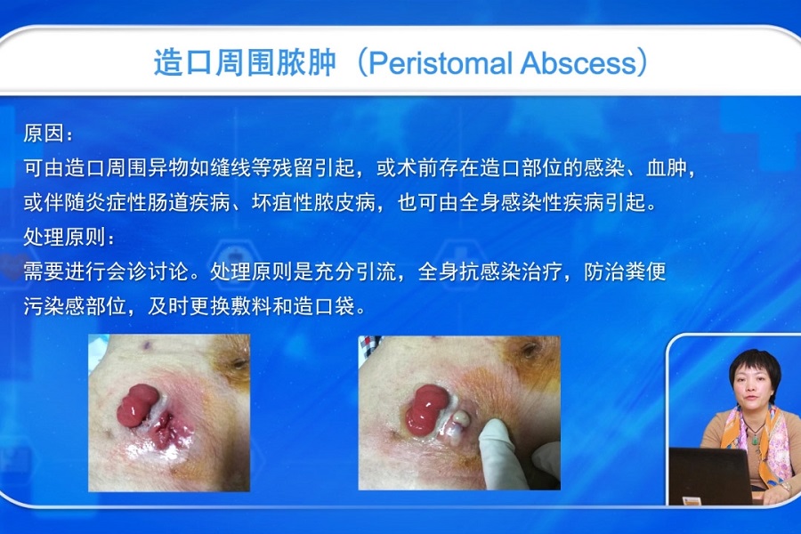 《护理大讲堂》2019年第4讲（总第4讲）造口周围皮肤并发症管理（下）